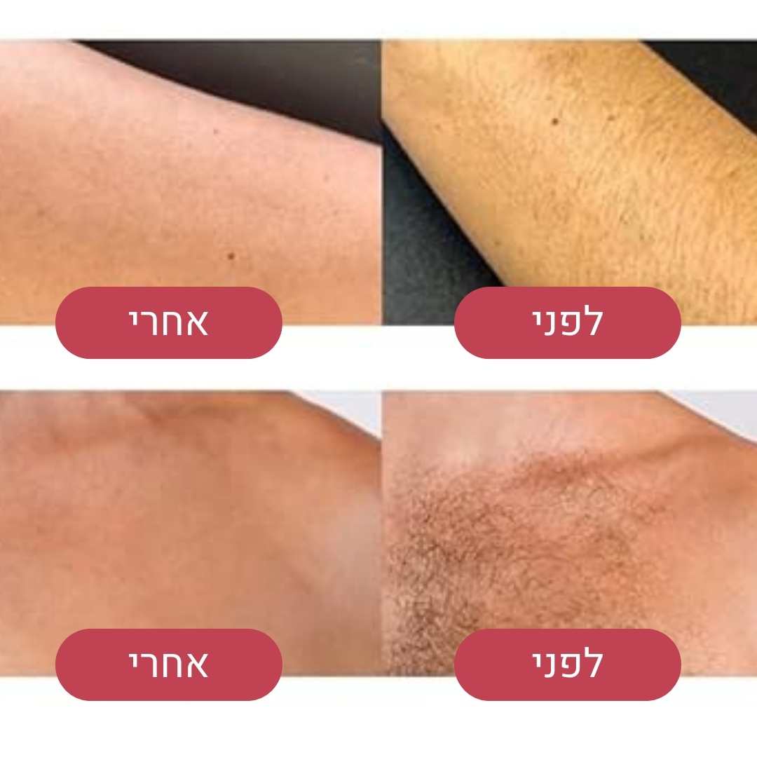 אבן הקסם להסרת שיער - הסרת שיער מיידית, חלקה וללא כאב