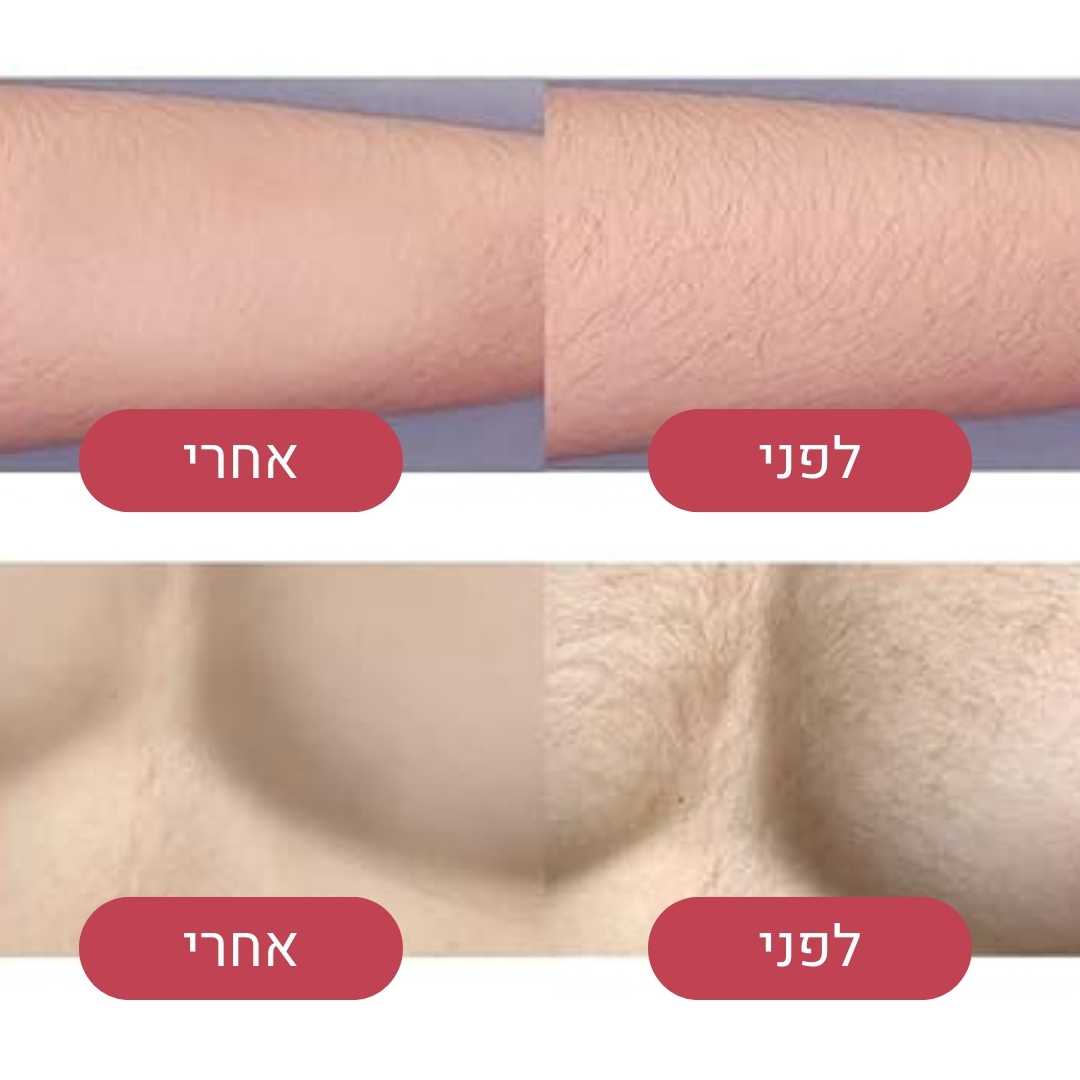 אבן הקסם להסרת שיער  - הסרת שיער מיידית, חלקה וללא כאב